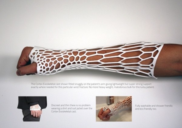 3D printed cast for broken bones